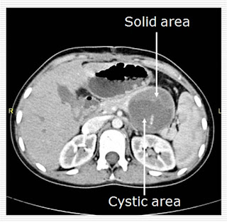 Cystic tumor of Pancreas