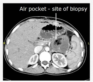 Cystic tumor of Pancreas