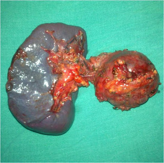 Solid Pseudopapillary Tumor