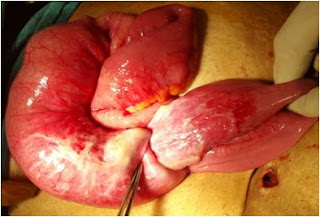 Adult Intussusception, gi cancer india