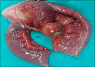 Lead point - pedunculated ileal tumor