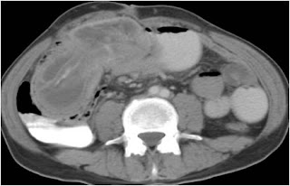Intussusception with intramural air