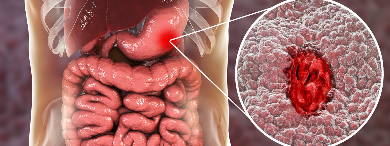 all-about-gastric-cancer all about gastric cancer