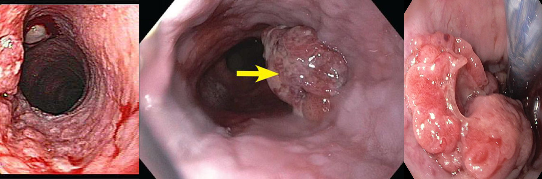 osephagus cancer osephagus cancer