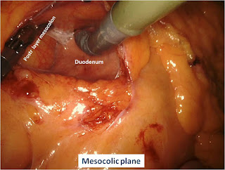 Minimally Invasive Colorectal Surgery