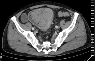 Colon cancer: Generalized peritoneal pigmentation Colon cancer: Generalized peritoneal pigmentation