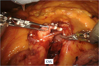 Minimally Invasive Colorectal Surgery