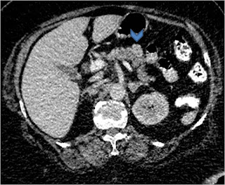 Insulinoma: Enucleation Insulinoma: Enucleation