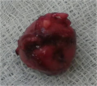 Insulinoma: Enucleation Insulinoma: Enucleation