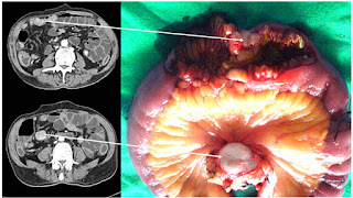 Primary hepatic neuroendocrine tumor