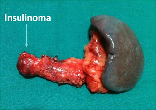 Insulinoma: Enucleation Insulinoma: Enucleation