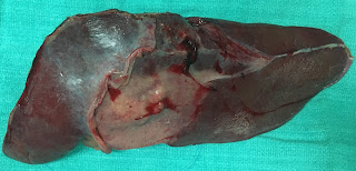 Surgery for intrahepatic cholangiocarcinoma (IHC) Surgery for intrahepatic cholangiocarcinoma (IHC)