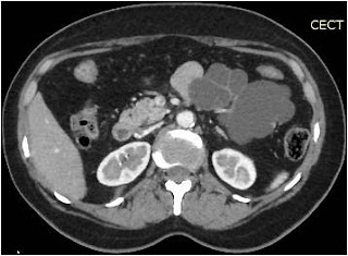 Serous Oligocystic Cystadenoma