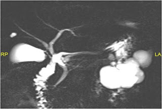 Serous Oligocystic Cystadenoma