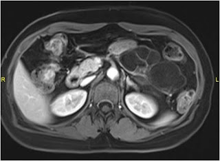 Serous Oligocystic Cystadenoma