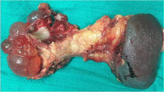 Serous Oligocystic Cystadenoma