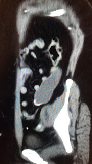 Tumors of Appendix Tumors of Appendix