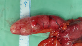 Tumors of Appendix Tumors of Appendix
