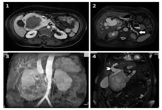 Ascites following Whipple's procedure (Pancreatoduodenectomy) Ascites following Whipple's procedure