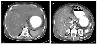 Ascites following Whipple's procedure (Pancreatoduodenectomy) Ascites following Whipple's procedure (Pancreatoduodenectomy)