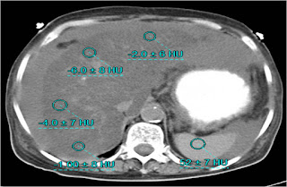 Ascites following Whipple's procedure (Pancreatoduodenectomy) Ascites following Whipple's procedure