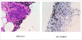 Colon cancer: Generalized peritoneal pigmentation Colon cancer: Generalized peritoneal pigmentation