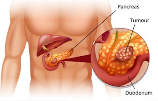 Pancreatic Tumors Pancreatic Tumors