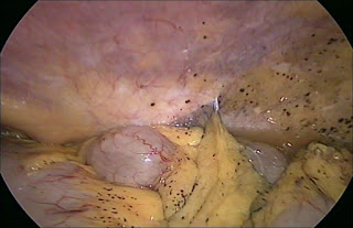 Peritoneal pigmented lesiosn Colon cancer: Generalized peritoneal pigmentation