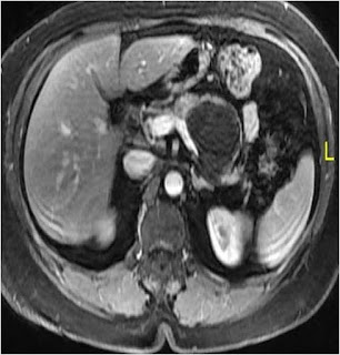 Mucinous Cystic Neoplasm (MCN) of Pancreas Mucinous Cystic Neoplasm (MCN) of Pancreas