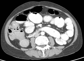 Surgery for colorectal cancer (CRC) Surgery for colorectal cancer (CRC)