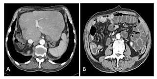 Primary hepatic neuroendocrine tumor