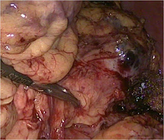 Management of Neuroendocrine Liver Metastases Management of Neuroendocrine Liver Metastases
