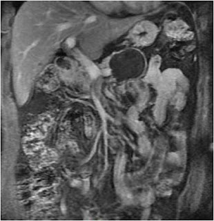 Mucinous Cystic Neoplasm (MCN) of Pancreas Mucinous Cystic Neoplasm (MCN) of Pancreas