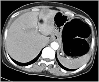 Surgery for colorectal cancer (CRC) Surgery for colorectal cancer (CRC)