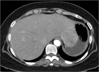 Management of Neuroendocrine Liver Metastases Management of Neuroendocrine Liver Metastases