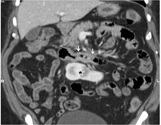 Cancer of distal duodenum: Whipple's procedure Cancer of distal duodenum: Whipple's procedure