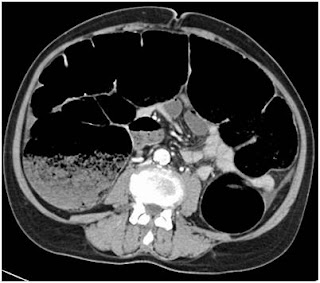 Surgery for colorectal cancer (CRC) Abdominal CT scan showing closed obstruction of large bowel