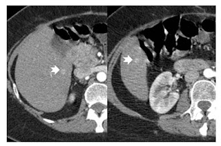 Management of Neuroendocrine Liver Metastases Management of Neuroendocrine Liver Metastases