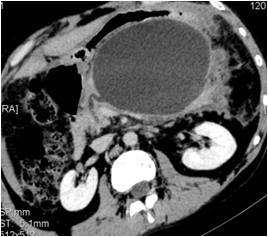 Mucinous Cystic Neoplasm (MCN) of Pancreas Mucinous Cystic Neoplasm (MCN) of Pancreas