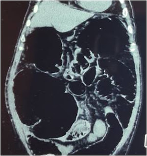 Surgery for colorectal cancer (CRC) Surgery for colorectal cancer (CRC)