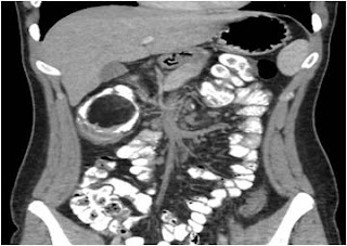 Lipoma ascending colon, gi cancer india Lipoma ascending colon