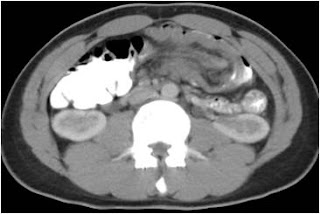 Intussusception with intramural air Colo-colic intussusception - Lipoma as lead point