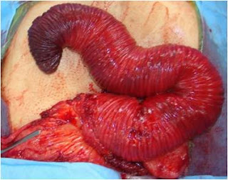 Intussusceptum with gangrenous tip Intussusceptum with gangrenous tip