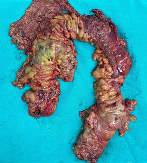 colon cancer in the background of ulcerative colitis