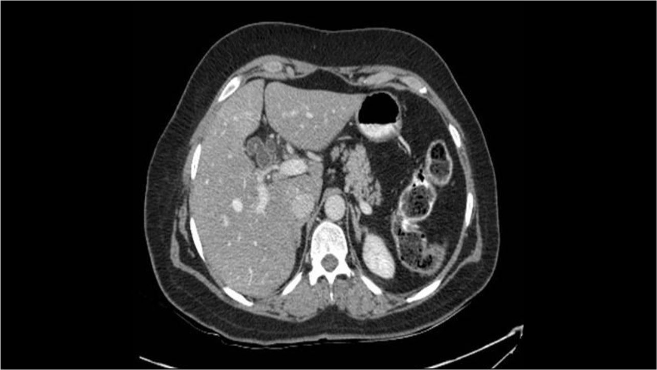 Adult choledochal cyst with gallbladder cancer