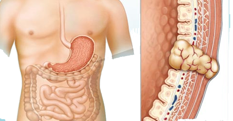 gastrointestinal stromal tumors (gist)