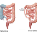 Colectomy procedure to remove one side of the colon is hemicolectomy