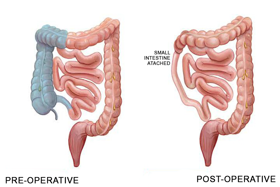 Colectomy procedure to remove one side of the colon is hemicolectomy